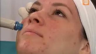 	Elimina el acn&eacute; en la cara con este tratamiento de 5 pasos.