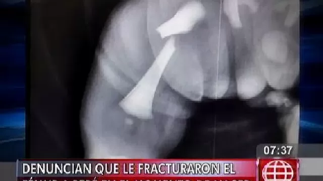 Hospital Carrión: Denuncian que fracturaron fémur de un bebé al momento de nacer
