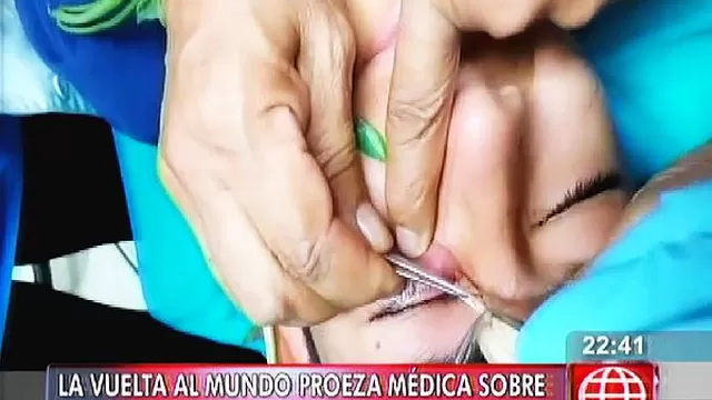 Dio la vuelta al mundo la extracción de gusano del ojo de un joven por médicos peruanos