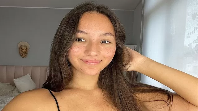 Alexia Barnechea y su reflexión tras dar conocer que sufre de acné 