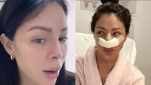 Sheyla Rojas: Así quedó su nariz tras cirugía reconstructiva
