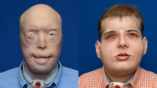 Estados Unidos: realizan trasplante de cara a rescatista desfigurado