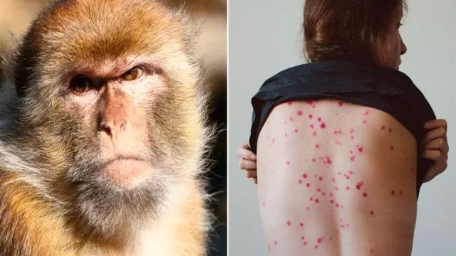 Viruela del mono: Se registra primer caso en Suecia