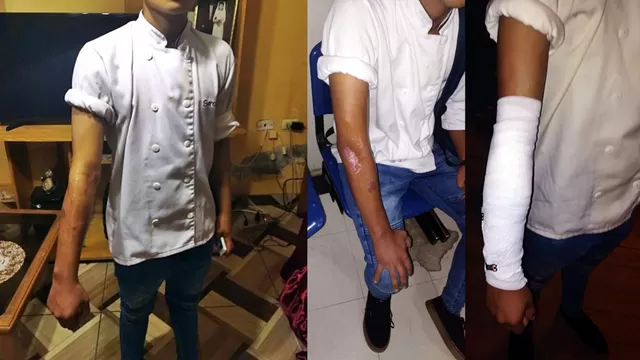 Joven cocinero de Sarcletti sufrió quemadura. Fotos: Twitter @acossiop