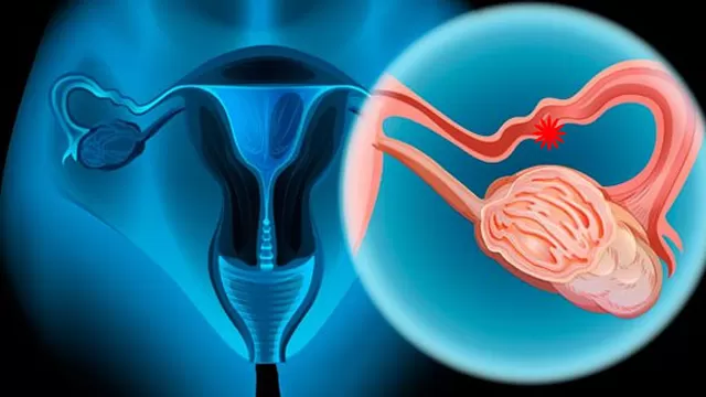 Síntomas y factores de riesgo del cáncer de ovarios