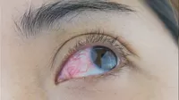 Carnosidad en los ojos: ¿Cómo empieza y cuáles son los síntomas?