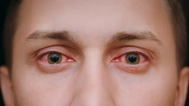 El enrojecimiento de los ojos es uno de los síntomas más comunes de la conjuntivitis.