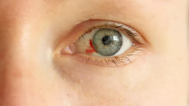 Causas del derrame ocular