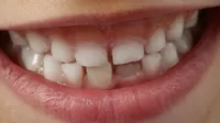 Pérdida temprana de los dientes de leche provoca dentadura chueca