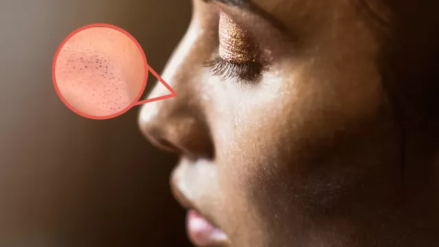 El acné aparece con mayor frecuencia en la zona T del rostro, pecho y la espalda.