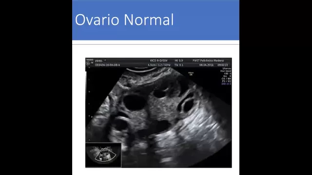 Ecografía de un ovario normal en una mujer. (Imagen: Dr. Alfredo Celis)