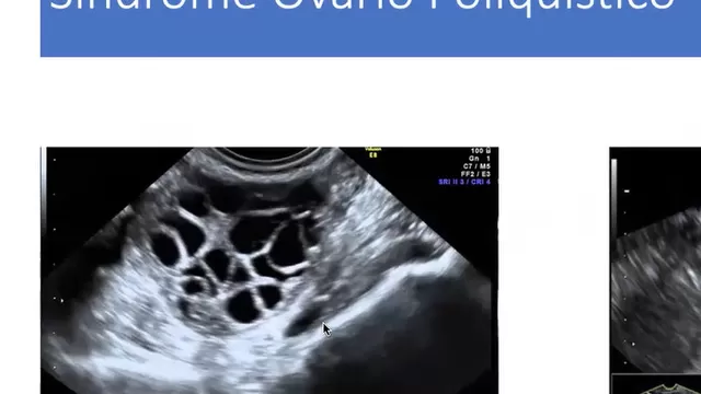 Ecografía de un ovario poliquístico. (Imagen: Dr. Alfredo Celis)