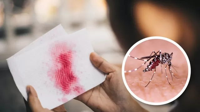 Los síntomas del dengue en adultos y niños