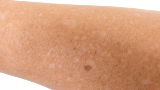 ¿Por qué salen estas manchas blancas en la piel?