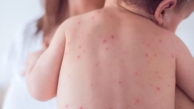 Diferencias entre la varicela y sarampión