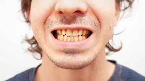 Tres formas comprobadas de blanquear tus dientes