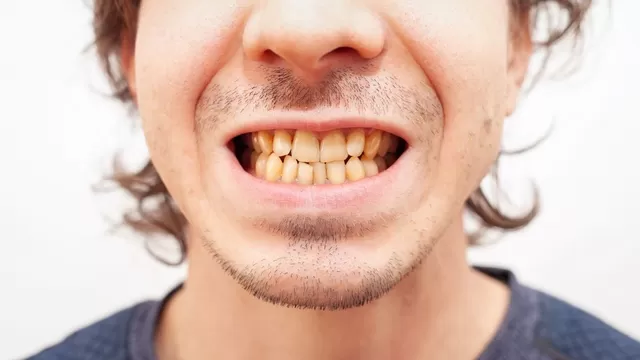 Las formas comprobadas de blanquear tus dientes