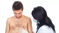¿Por qué puede ser peor la varicela en adultos que en niños?