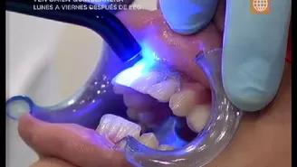 	Blanqueamiento dental: Todo lo que debes saber antes de hac&eacute;rtelo.