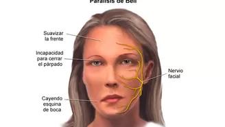 Parálisis facial: pasos para acelerar la recuperación