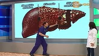Síntomas y recomendaciones para el hígado graso