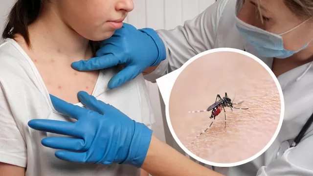 Estos son los síntomas del dengue en casos leves y severos. 