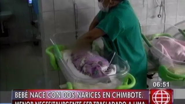 Áncash: bebé que nació con dos narices necesita ser trasladado a Lima