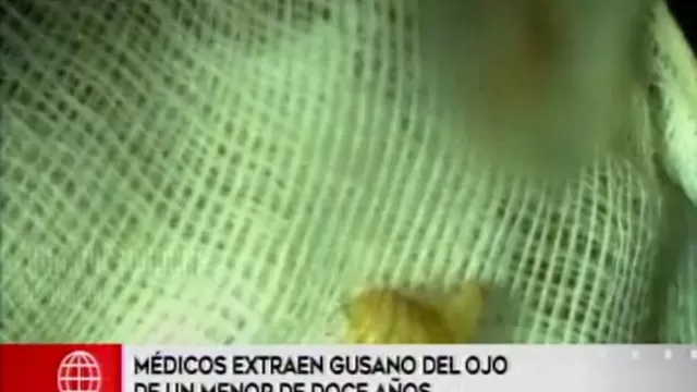 Bagua: médicos extrajeron un gusano del ojo de un menor de 12 años 