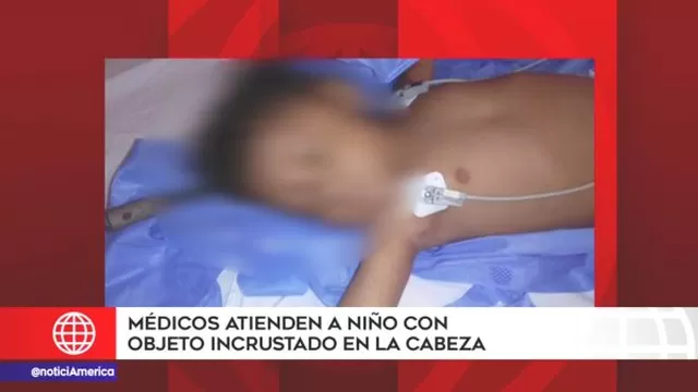 Operaron con éxito a niño evacuado de Bagua con objeto incrustado en la cabeza