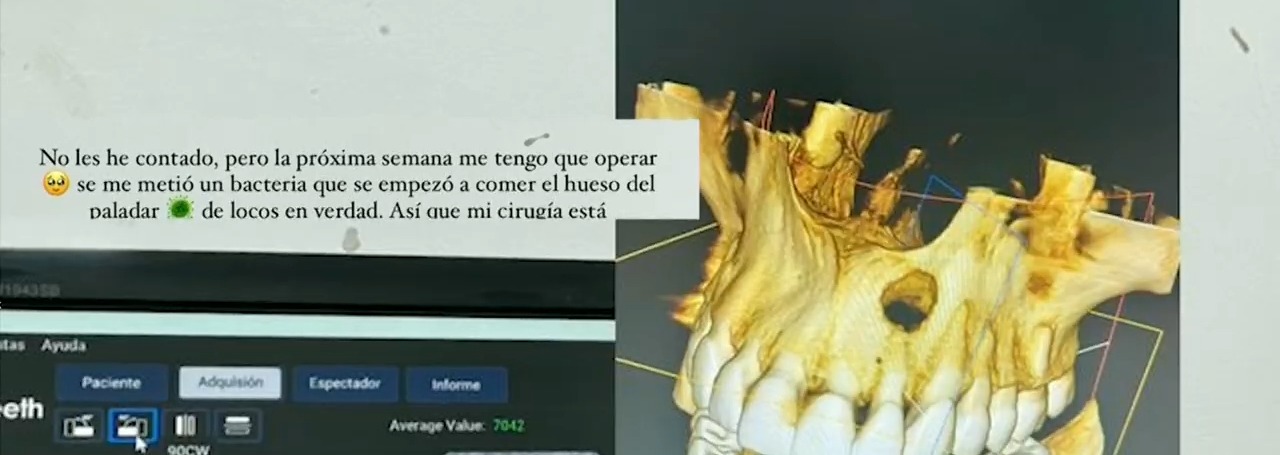 Valeria Piazza reveló que adquirió una infección bacteriana que ha dañado parte de su paladar y por este motivo será operada el miércoles 19 de  octubre / Foto: Instagram