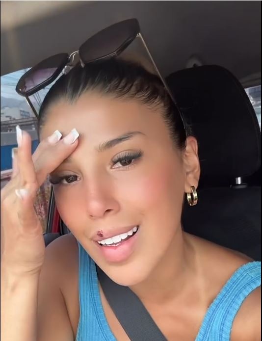 Yahaira Plasencia reapareció en sus redes sociales con una gran herida en uno de sus labios y preocupó a sus seguidores/Foto: instagram