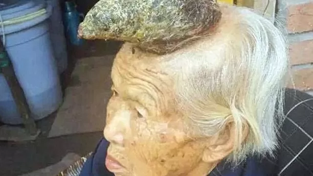 La protuberancia en la cabeza de Liang Xhizhen mide 12 cent&iacute;metros. Via: Daily Mail