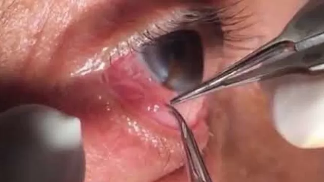 YouTube: médicos extraen gusano de 15 centímetros del ojo de hombre en la India