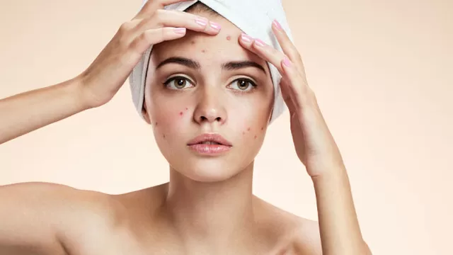 Remedios caseros que no debes usar para combatir el acné Foto: Shutterstock