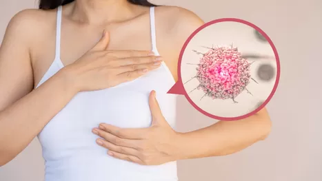 Cáncer de mama: ¿En qué casos se hace una mastectomía?
