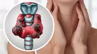 Cáncer de tiroides: cómo detectarlo y cuáles son los síntomas