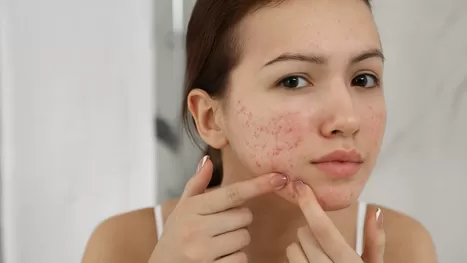Las formas más efectivas de borrar las marcas que deja el acné