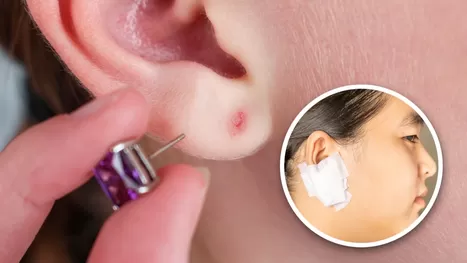 Se me infectó la oreja por perforarme un arete: ¿Cómo se cura?