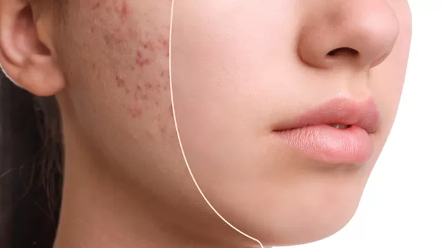 ¿Cuál es el tratamiento efectivo para el acné por SOP?