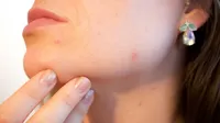 Estos hábitos te ayudarán a eliminar las cicatrices del acné