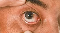 ¿Cómo es la operación que elimina la carnosidad en los ojos?