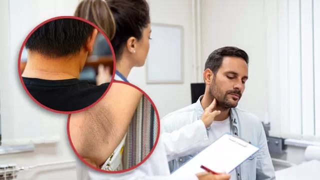 Tratamiento para las manchas oscuras en el cuello a causa de acantosis nigricans.