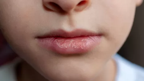 ¿Cómo regenerar los labios secos y agrietados?