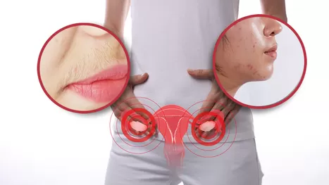 ¿Cuáles son las manifestaciones del síndrome de ovario poliquístico?