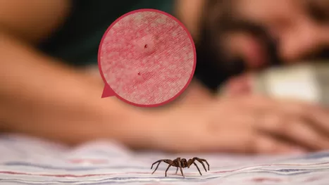 ¿Cuándo hay que preocuparse por una mordedura de araña?