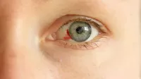 ¿Por qué aparecen manchas de sangre en el ojo?