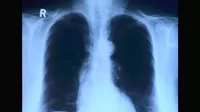 Placa de rayos X y tomografía: cuál es mejor para evaluar el pulmón