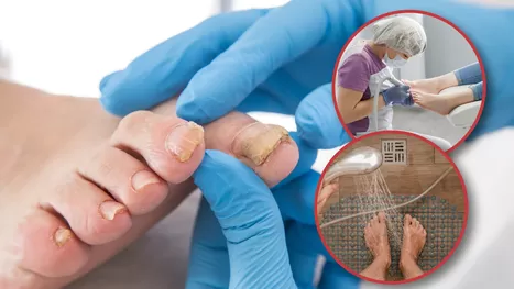 ¿Dónde hay mayor riesgo de contraer hongos en las uñas y los pies?