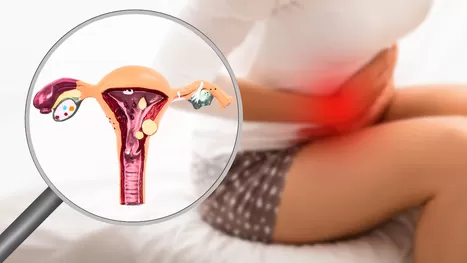 6 se&ntilde;ales de endometriosis y que confundes con dolor menstrual