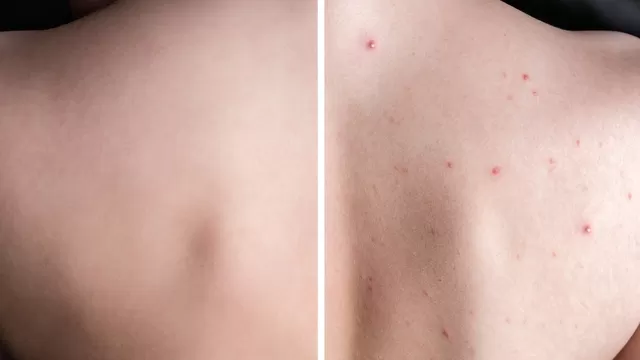 El acné o granitos en la espalda
